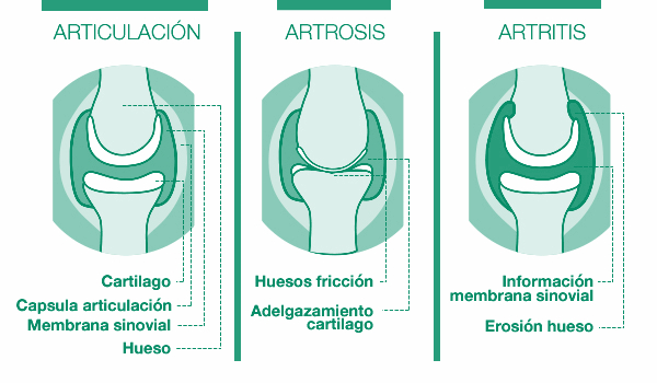Diferencia entre Artrosis y Artritis